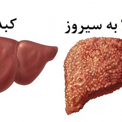 liver-cirrhosis-1